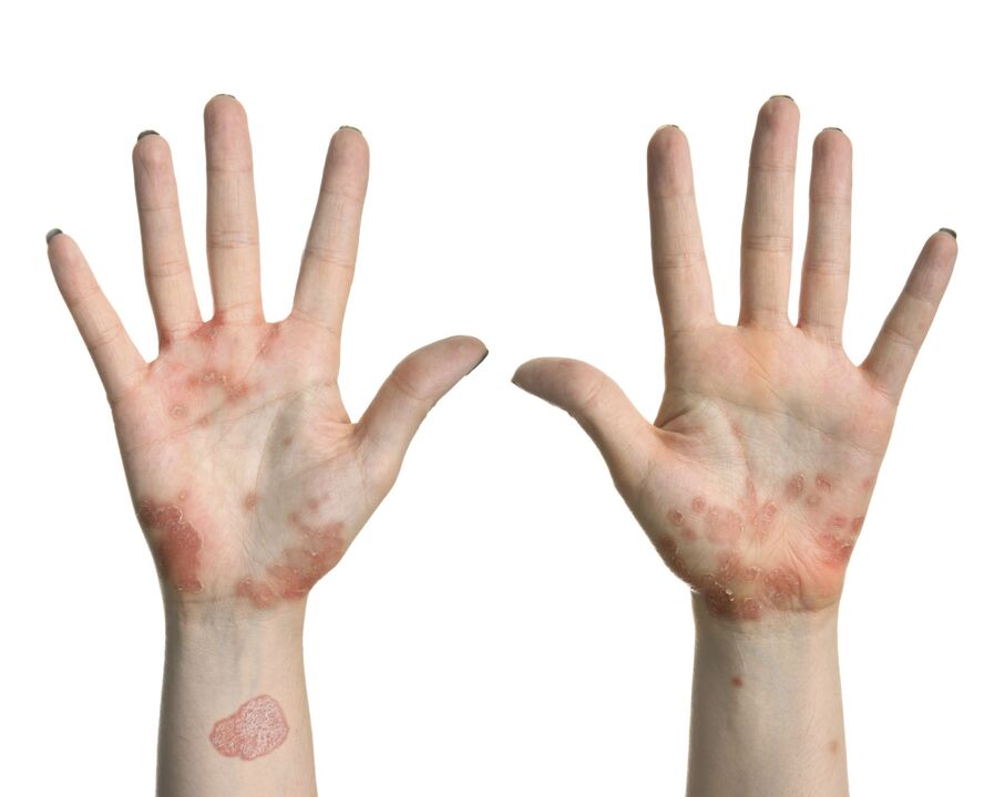 Psoriasis on the hands